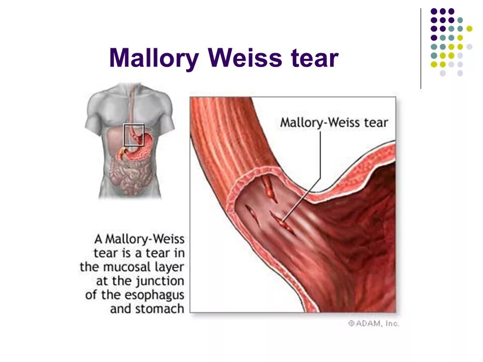 Кровотечение из желудка пищевода. Синдром Маллори Вейсса. Синдром Маллори-Вейсса это что такое Мэллори Вейса. Синдром Мэллори Вейса эндоскопия. Синдром Мэллори Вейса степени.