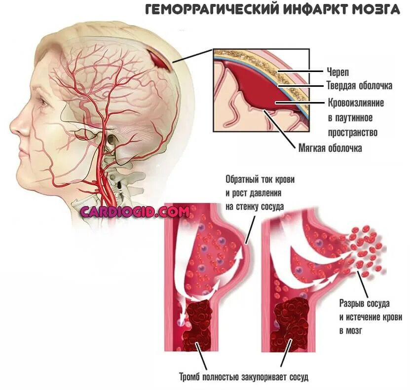 Ишемический инсульт поражения артерий. Инфарктголовногомозка. Ишемический инфаркт головного мозга.