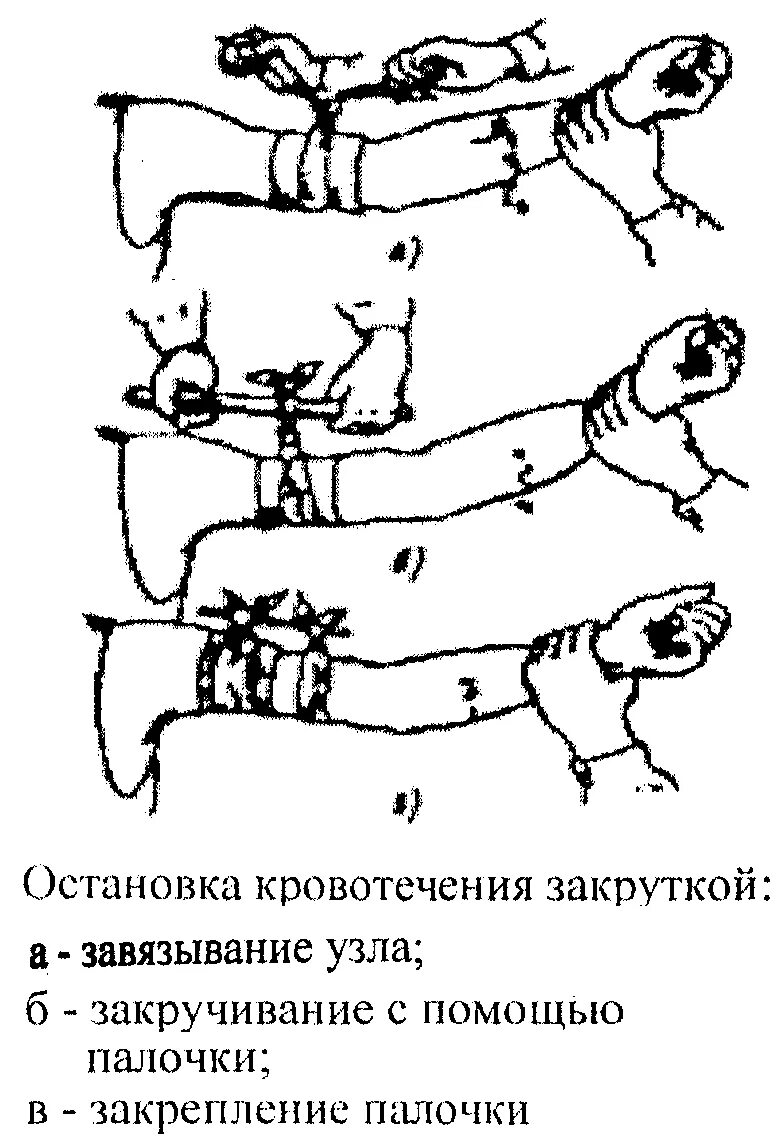 Остановка кровотечения методом закрутки. Артериальное кровотечение закрутка. Остановка артериального кровотечения с помощью закрутки. Остановка наружного кровотечения закруткой. Останавливать кровотечение путем