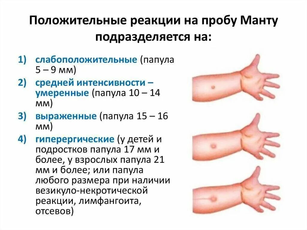 Реакция манту норма у детей 12 лет. Туберкулиновая проба манту норма. Туберкулиновая проба диаскинтест нормы. Туберкулиновая проба реакция манту у детей. Реакция манту как часто