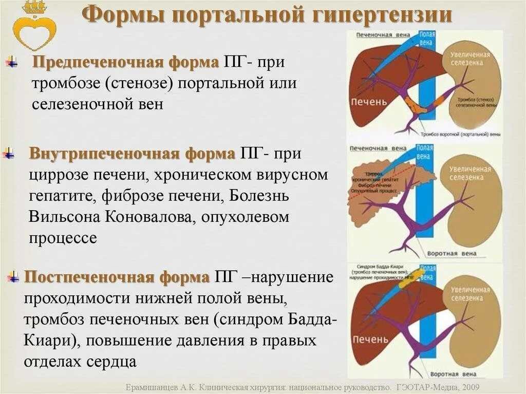 Тромб в печени