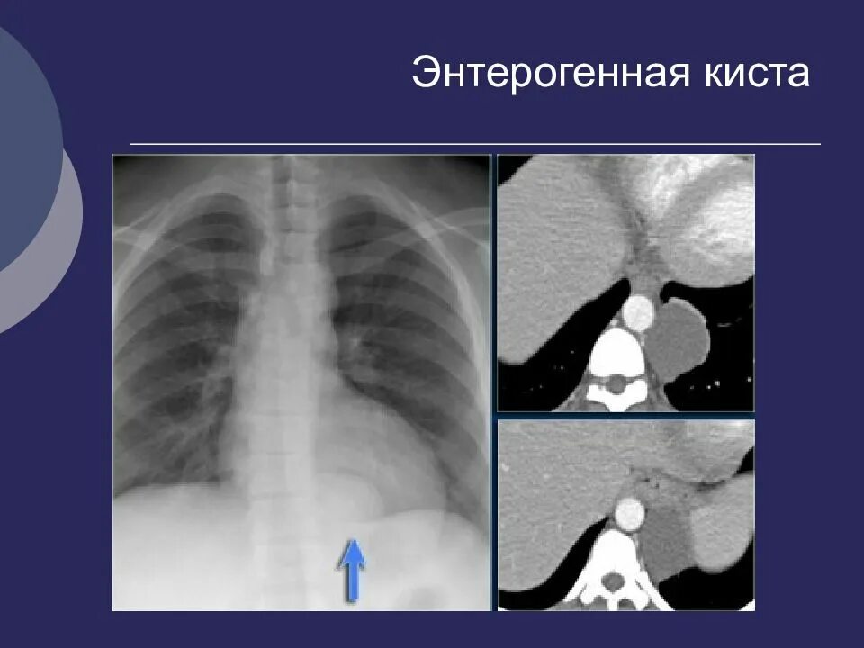 Киста пищевода. Бронхогенная киста средостения рентген. Бронхогенная киста средостения на кт. Энтерогенная киста средостения на кт.