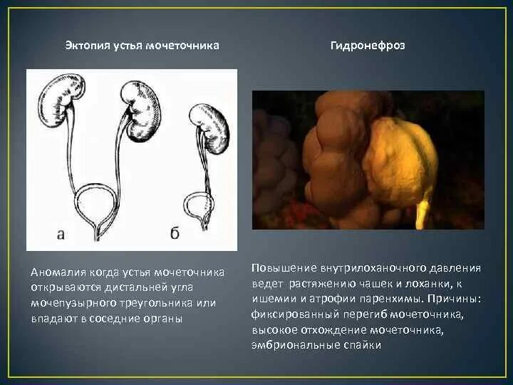 Развитие мочеточников. Шеечная эктопия мочеточников. Эктопия устья мочеточника. Эктопия и дистопия устья мочеточника. Эктопия отверстия мочеточника.