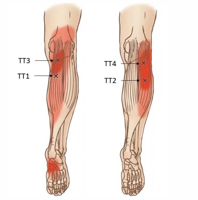 Сильная боль в икроножной. Иннервация икроножной мышцы голени. Триггерные точки икроножной мышцы. Сухожилие икроножной мышцы. Кровоснабжение икроножной мышцы.