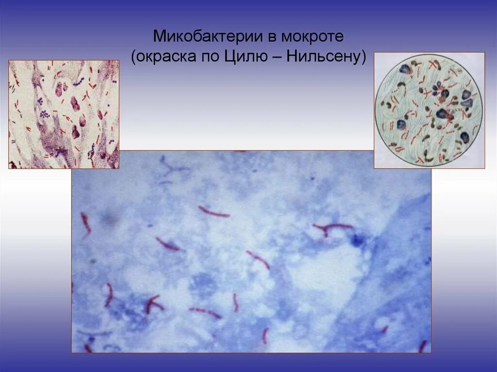 Mycobacterium tuberculosis в мокроте окраска по Цилю Нильсену. Микобактерии Циль Нильсен. Окрашивание микобактерий туберкулеза по Цилю Нильсену. Микроскопия по Цилю-Нильсену.