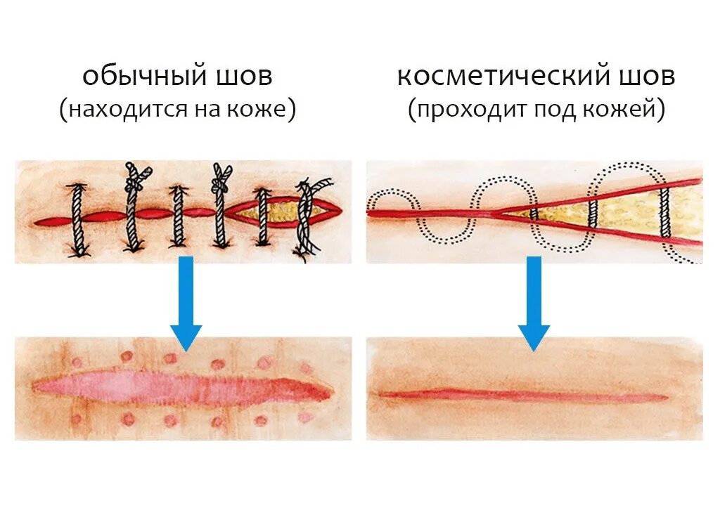 Через сколько можно мочить шов