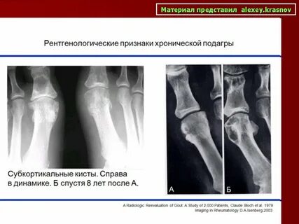 Рентгенологические признаки подагры