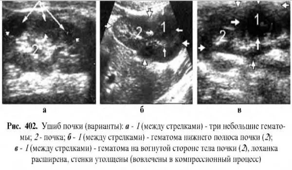 Почки головокружение. Почки головокружение