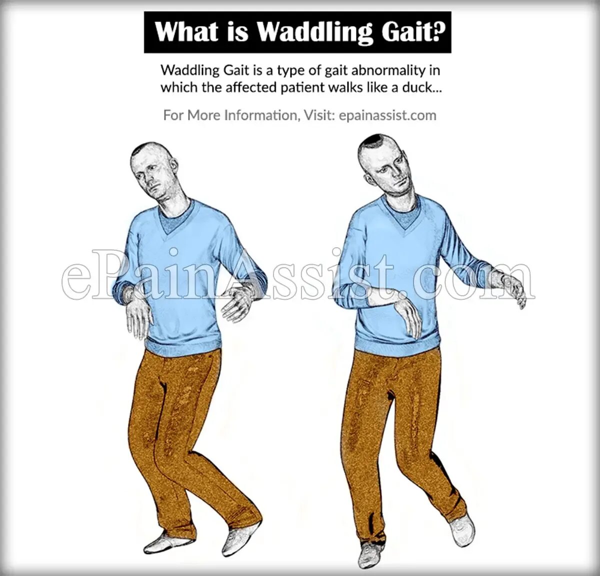 Походка степпаж. Waddling gait. петушиная походка степпаж. gait abnormality. spastic gait.
