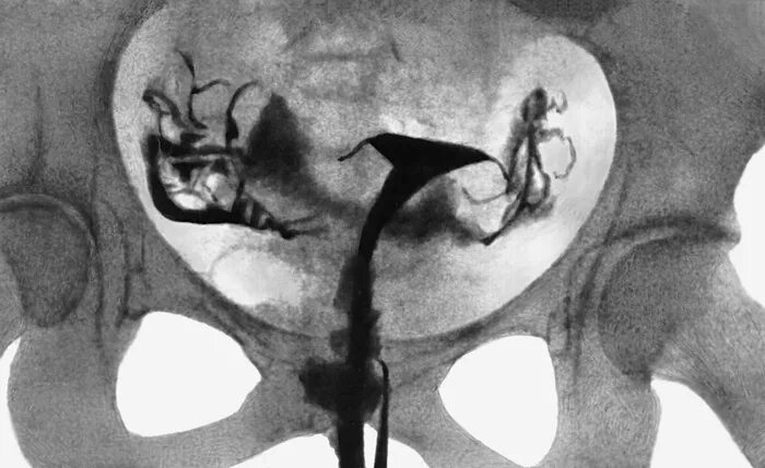 Операция проходимость труб. Врожденная непроходимость маточных труб. Гистеросальпингография непроходимость маточных труб. Гистеросальпингография двурогая матка. Гистеросальпингография (метросальпингография) МСГ.