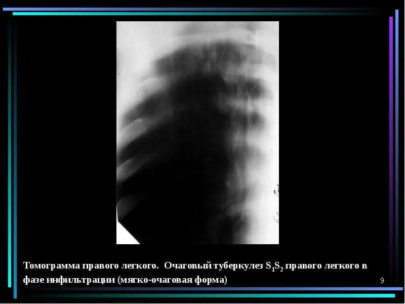 Очаговое образование в правой доле в. Очаговый туберкулез томограмма. Линейная томограмма легких при туберкулезе. Томограмма инфильтративном туберкулеза. Очаговый туберкулез на кт.