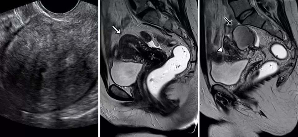 Узи признаки эндометриоза матки. Очаговый аденомиоз матки мрт. Эндометриоз аденомиоз матки. Ретроцервикальный эндометриоз мрт.
