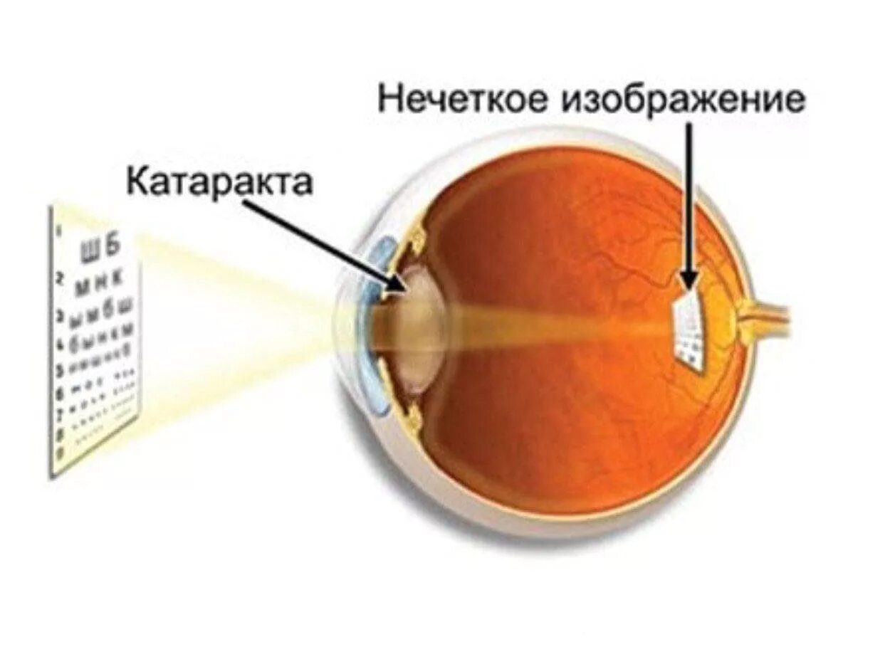 Отверстие через которое внутрь глаза проникает свет. Катаракта схема глаза. Катаракта глаза катаракта схема. Эмметропическая рефракция. Эмметропия миопия.