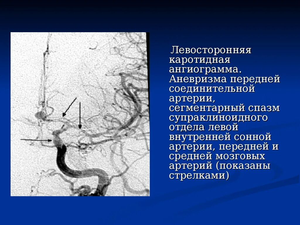 Фузиформная аневризма внутренней сонной артерии. Супраклиноидная аневризма. Аневризма передней соединительной артерии кт. Церебральная ангиограмма.