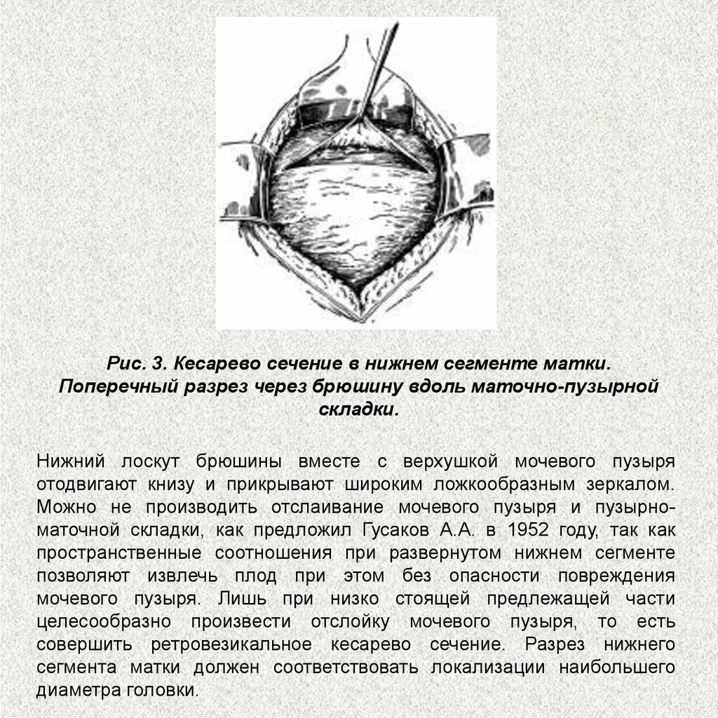 Кесеровое сечение. Кесарево сечение в Нижнем маточном сегменте поперечным разрезом. Кесарево сечение в Нижнем сегменте матки алгоритм. Кесарево сечение по методу Штарка. Техника операции кесарево сечение в Нижнем сегменте.