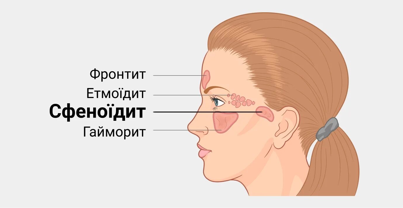 Сфеноидит симптомы. Хронический сфеноидит симптомы. Острый сфеноидит симптомы. Острые и хронические сфеноидиты.