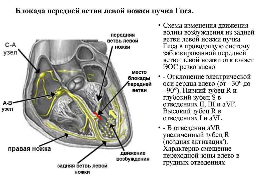 блокада правой ножки и левой передней ветви пучка гиса. пучок гиса в сердце блокада левой ножки. двухпучковая блокада ножек пучка гиса. блокада правой ножки пучка гиса на экг что это на экг. блокада передней ветви правой ножки пучка гиса.