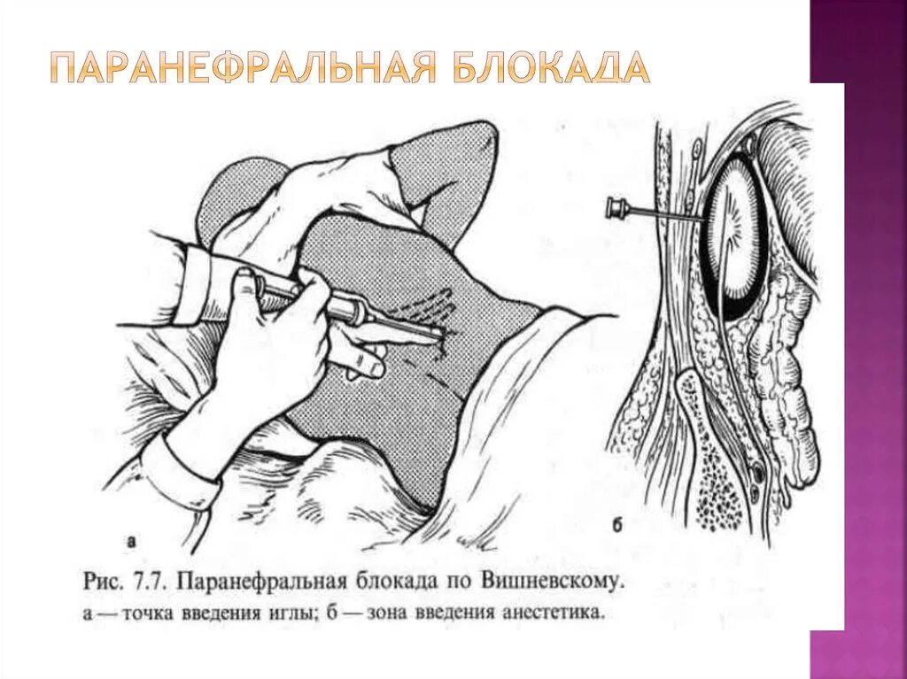 Блокада техника выполнения. Паранефральная блокада по Вишневскому. Поясничная паранефральная новокаиновая блокада. Двусторонняя паранефральная новокаиновая блокада. Схема поясничной паранефральной новокаиновой блокады.