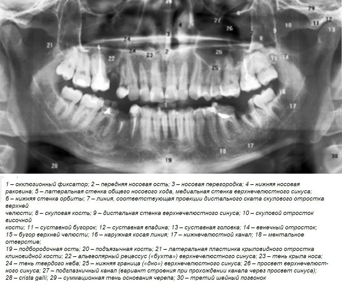 Снимок зубов видное. Ортопантомограмма челюсти. ОПТГ снимок расшифровка.