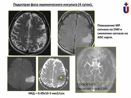 Ишемический инсульт на мрт