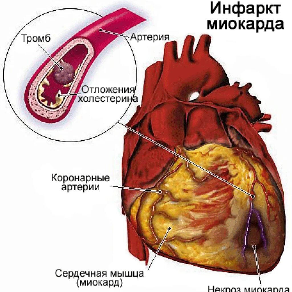 Тромб в желудочке