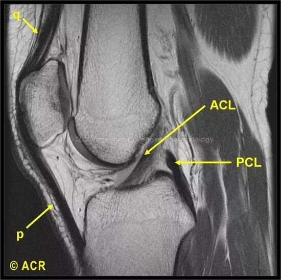 Acl это. Иллюстрация acl:. Acl это. Anterior cruciate ligament reconstruction. Медиальная коллатеральная связка.