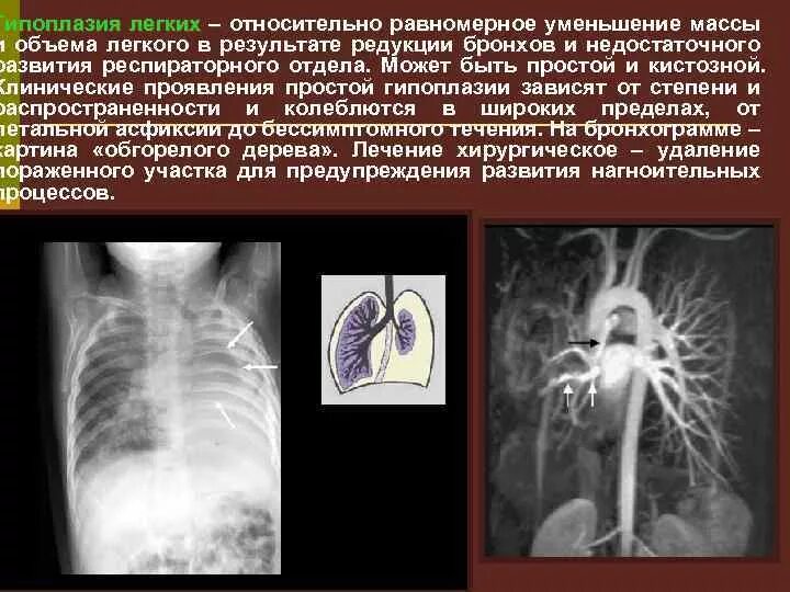 Гипоплазия респираторных отделов легкого. Уменьшение объема легких. Уменьшение объема легких снимок. Пороки развития дыхательной системы рентген. Почему уменьшается легкое