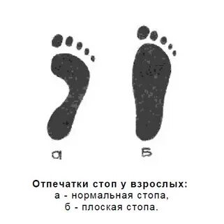 Плоская стопа код