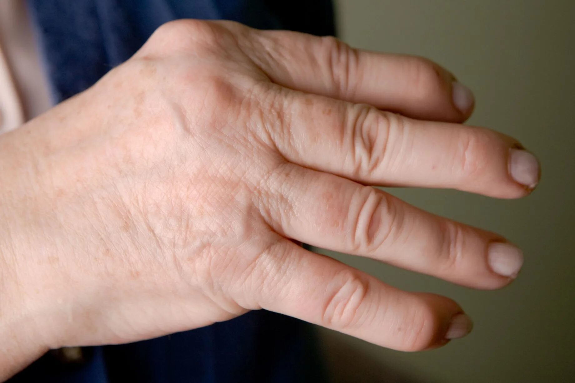 Больные пальцы рук. Псориазный ревматоидный артрит.