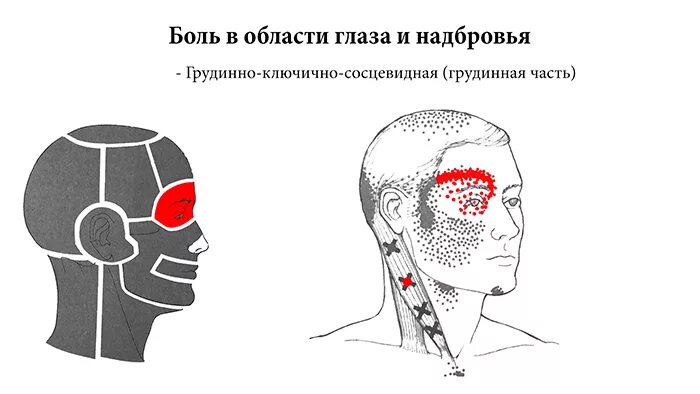 Сильные боли в области головы. Головная боль локализация. Головная боль схема. Типы головной боли.