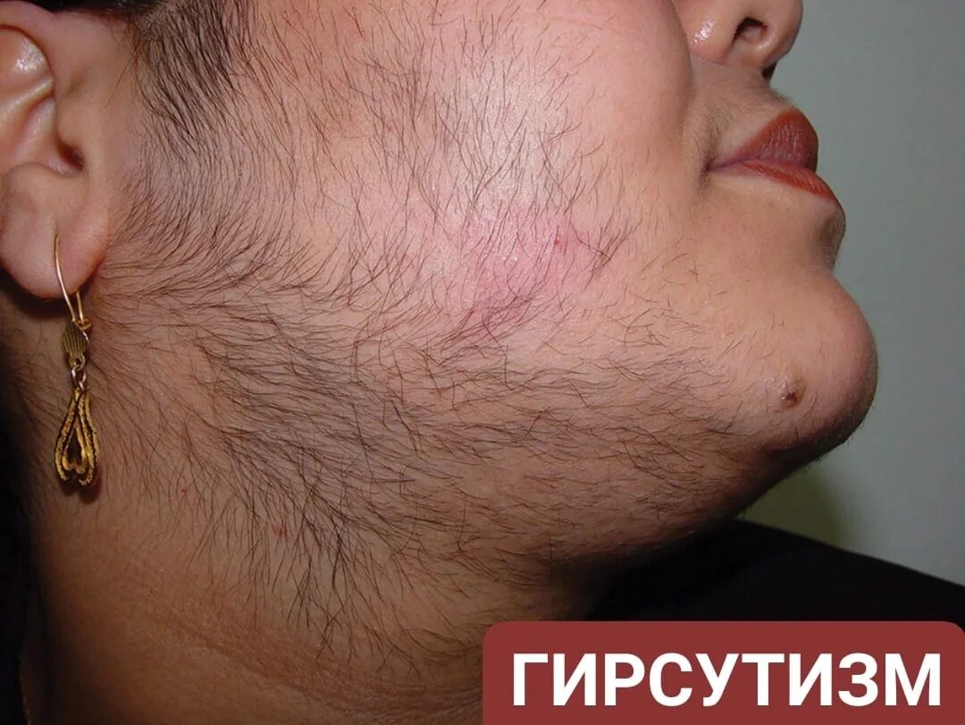 Конгенитальный гипертрихоз. Фолликулит, гипертрихоз. Гирсутизм акромегалия. Фолликулит, гипертрихоз. Волосяной покров головы.