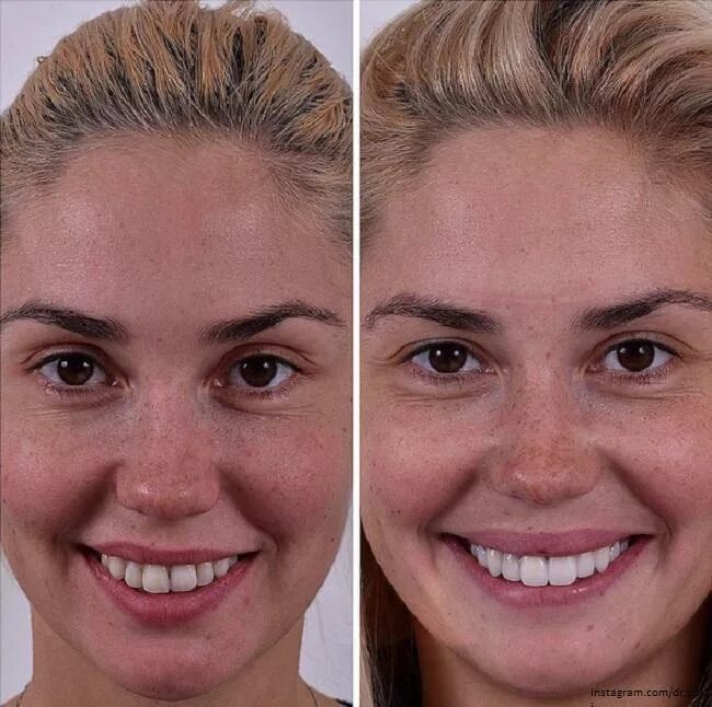 Исправление неправильного прикуса. Можно ли изменить зубы. Можно ли изменить зубы. Девушки с неправильным прикусом. Можно ли изменить зубы.