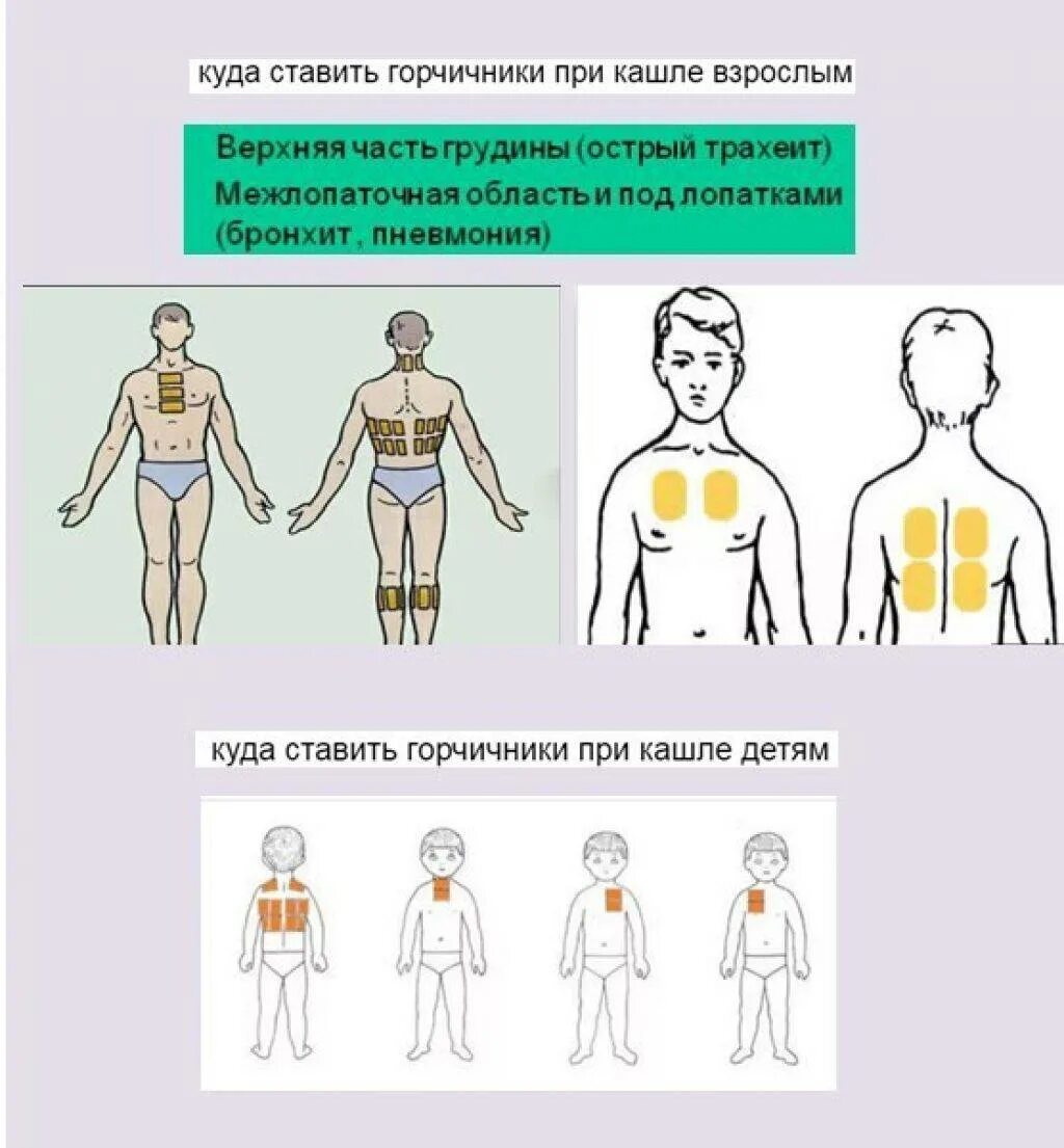 Сколько можно ставить горчичники взрослому. Места постановки горчичников при кашле. Как правильно наложить горчичники при кашле. Схема наложения горчичников при кашле. Правильно поставить горчичники при кашле.