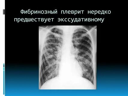Сухой плеврит