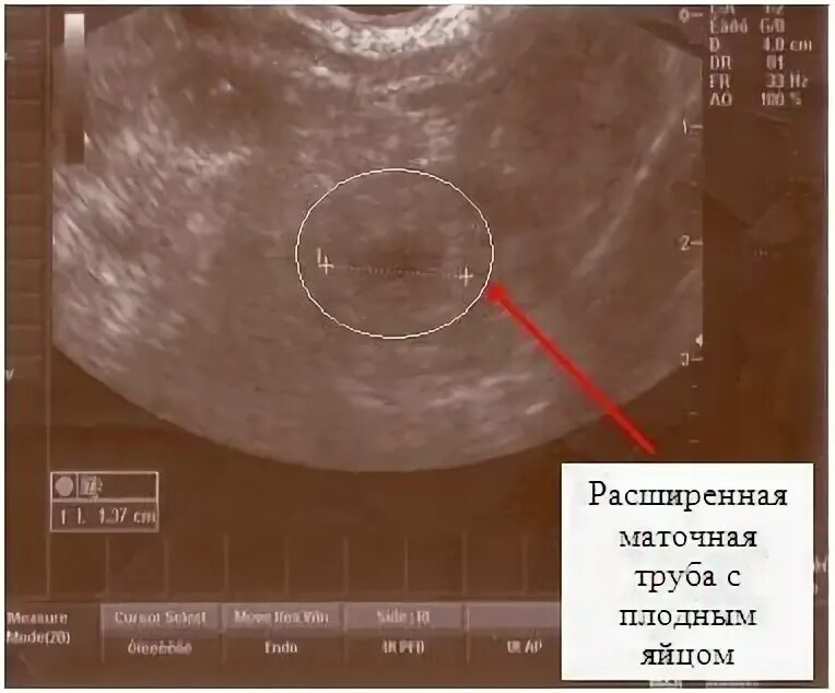 Маточная беременность на УЗИ на раннем сроке. Внематочная Трубная беременность УЗИ. УЗИ на 4 неделе внематочная бер. УЗИ матки на первых неделях беременности. На узи видно внематочную