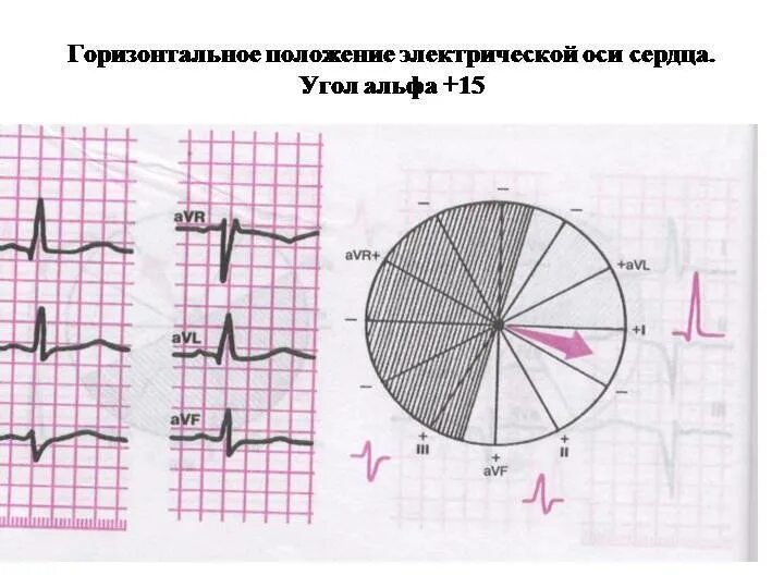 Горизонтальное положение это как. Горизонтальная ось сердца на ЭКГ. ЭОС сердца на ЭКГ горизонтальная. Угол Альфа 30 градусов на ЭКГ. ЭОС ЭКГ таблица.