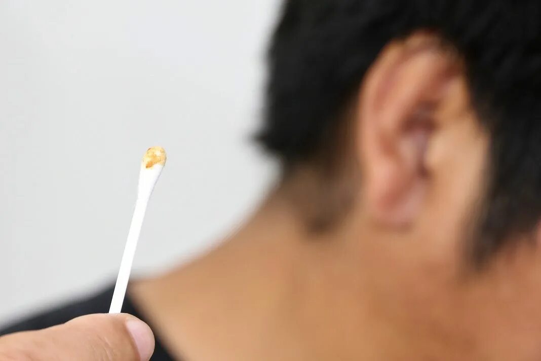Серная пробка ватные палочки. Ear wax. Отомикоз серная пробка. Ear wax. Ear wax.