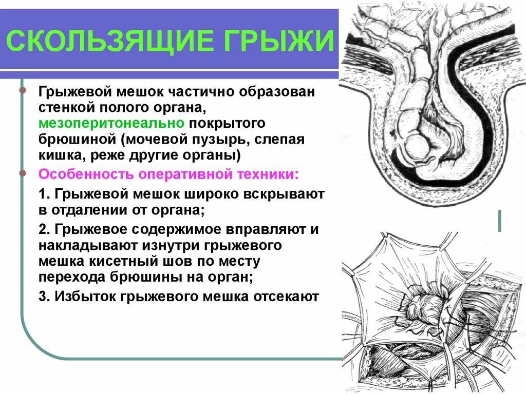 Грыжи тест. Скользящие грыжи топографическая анатомия. скользящая паховая грыжа топографическая анатомия. патогенез скользящей грыжи. хирургическая техника при скользящей грыже.