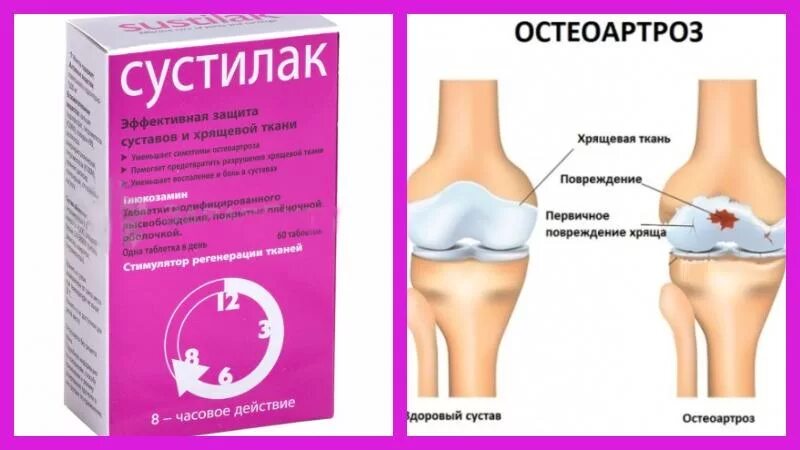 Сустилак для суставов отзывы. Сустилак. лекарство сустилак. сустилак уколы. сустилак 1500 мг.