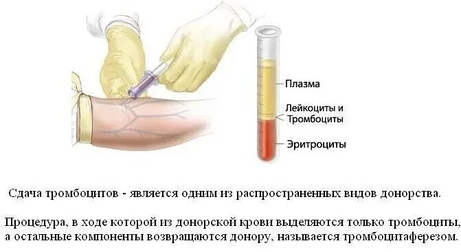 Сдача тромбоцитов последствия для донора. Сдача тромбоцитов. плюсы сдачи крови. минусы сдачи крови.