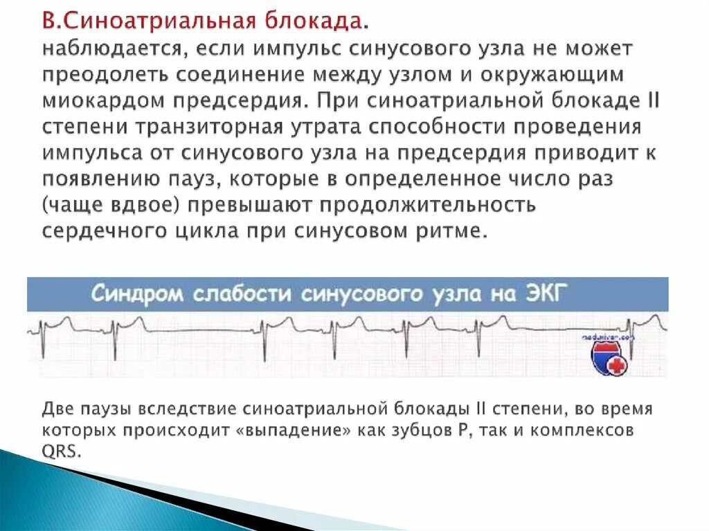 Блокада узла. Блокада синусового узла. Синдром слабости синусового узла. Слабость синусового узла синоатриальная блокада. АВ-блокада, синдром слабости синусового узла.