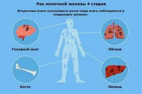 Рак 4 степени с метастазами сколько живут