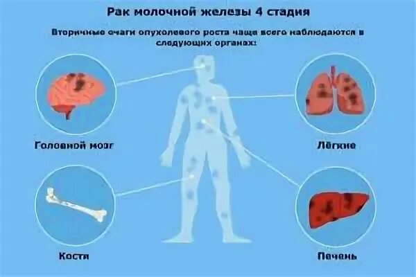 3 стадия рака с метастазами