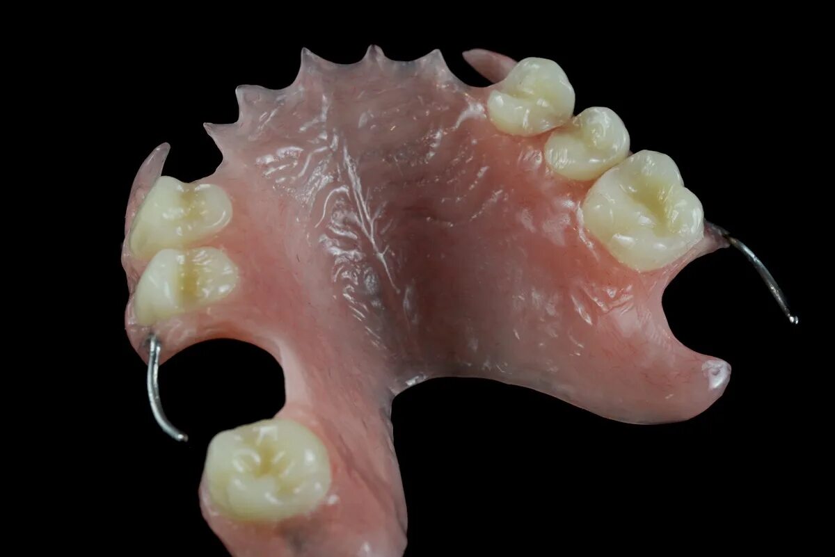 Частично съемный. Пластиночный протез на верхнюю челюсть. Нижний пластиночный протез. Частичный съемный пластиночный протез. Зубной протез acry-free (акри-фри).
