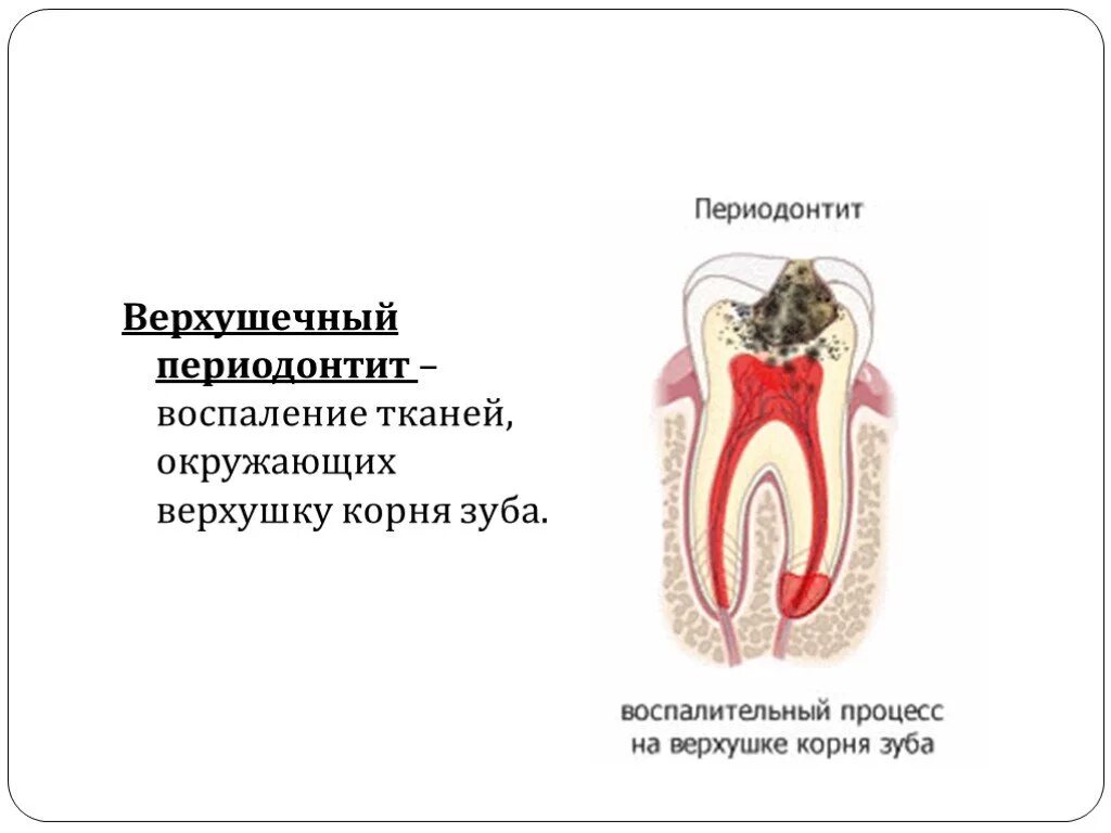 Формы острого апикального периодонтита. Гранулематозный апикальный периодонтит. Хронический периодонтит 28 зуба. Острый апикальный периодонтит пульпарного происхождения мкб 10. Осложнение лечения периодонтита