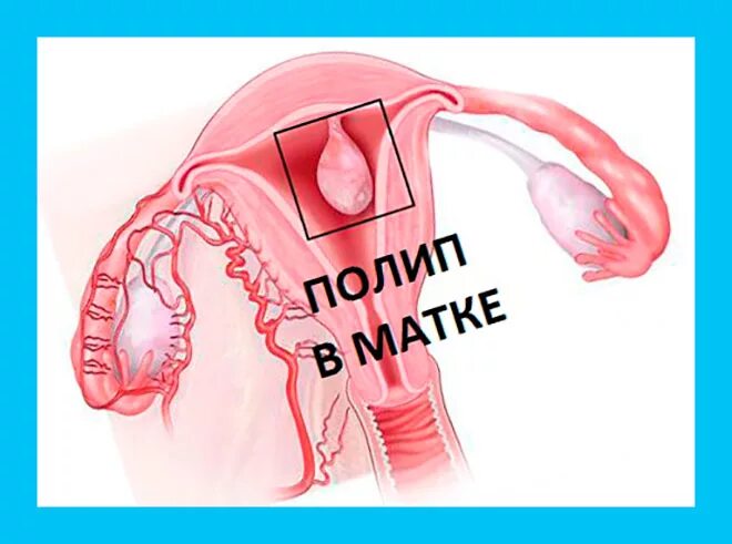 Полипы матки как проходит операция. Полипы в матке и зачатие. мешает ли полип в матке забеременеть.