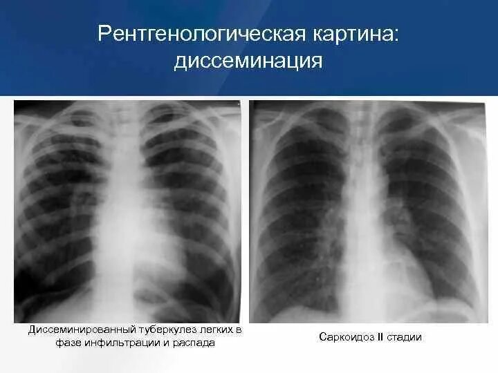 Бронхогенный диссеминированный туберкулез. Диссеминированный туберкулез в фазе инфильтрации. Бронхогенный диссеминированный туберкулез рентген. Подострый диссеминированный туберкулез рентген.