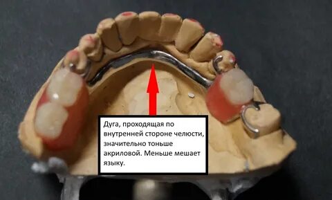 Бюгельная дуга