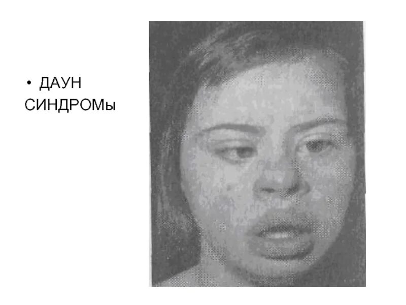Как выявить синдром дауна. Лицо дауна. люди с болезнью дауна.