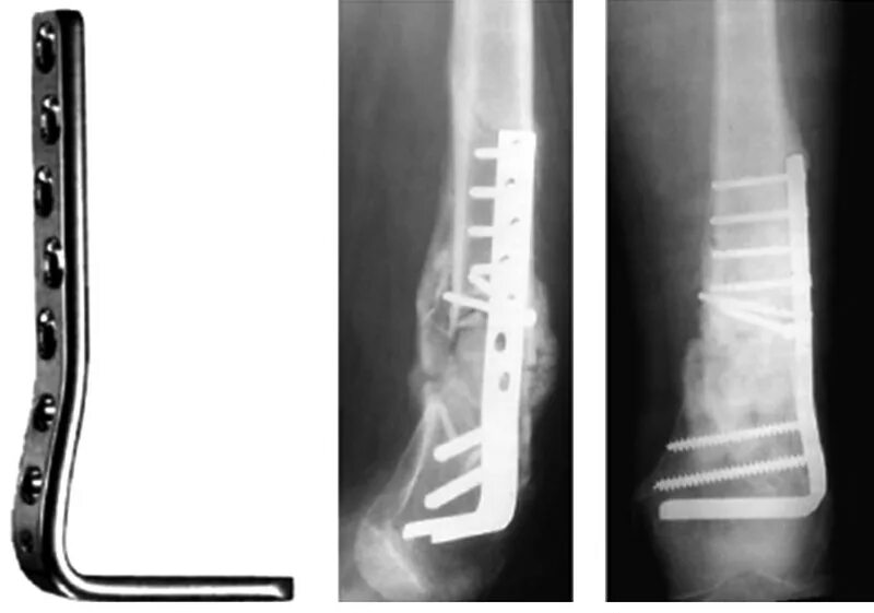 Надкостный остеосинтез голени. Внекостный остеосинтез. Перелом лодыжки с остеосинтезом. Остеосинтез операция пластины